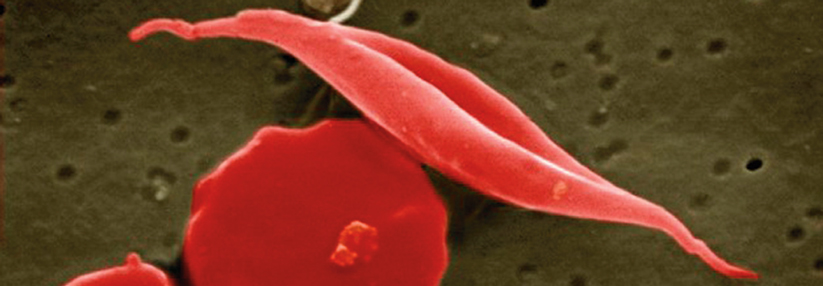 Das abnorme Hämoglobin bildet Fibrillen, welche die Erys in die Sichelform zwingen.
