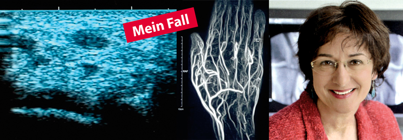 Farbdoppler und MR-Angio zeigen den Verschluss der rechten distalen A. ulnaris