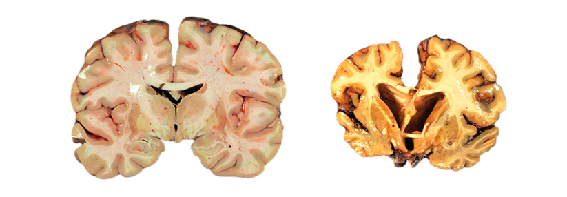 Im Vergleich: links ein gesundes Gehirn, rechts ein an chronisch traumatischer Enzephalopathie erkranktes Gehirn.