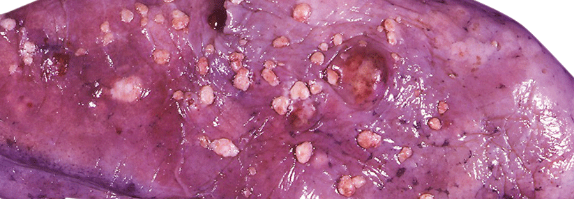 Metastasiertes Endometrium-Karzinom mit Absiedelungen in der Lunge.