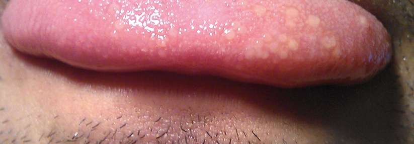 Typus herpetiformis auf der Zunge.