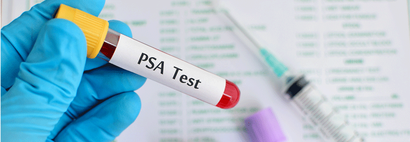 Prostata-Ca - Nach 20 Jahren Studie ein klares Ergebnis Prostata-Ca: Kombi von Bestrahlung und Antiandrogen verbessert bei biochemischem Rezidiv die Prognose.