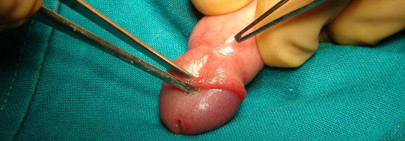 Operation des verengten Bereichs des männlichen Genitals.