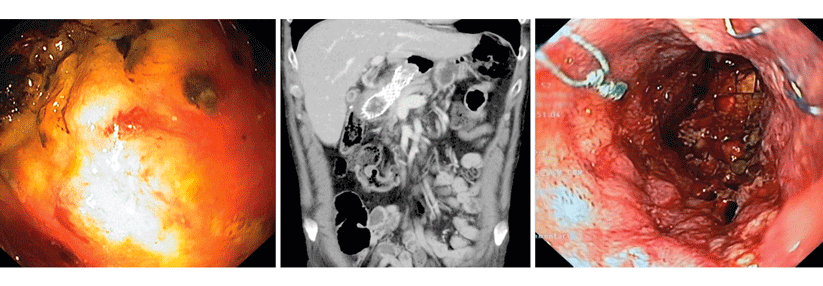 In diesem Lokalrezidiv nach Gastrektomie ist eine Stenose mit Nekrosehöhle sichtbar. Die Verengung ließ sich palliativ endoskopisch mittels Stent, der auch im Abdomen-CT zu erkennen ist, überbrücken.