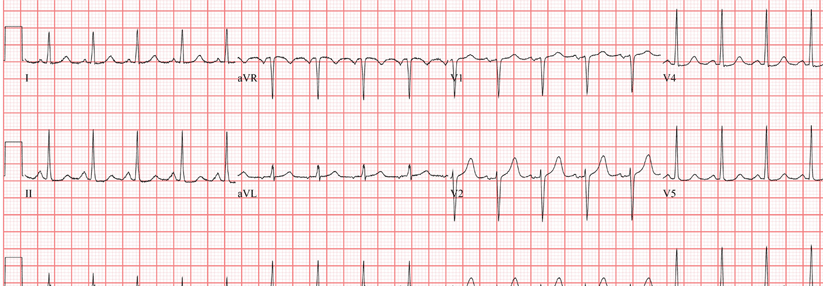 Ruhetachykardien (> 100/min) treten bei fortgeschrittenen kardialen Neuropathien auf.