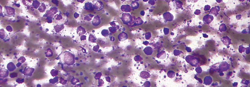 Die mikroskopische Aufnahme zeigt angefärbte DLBCL-Zellen in einem Lymphknoten.
