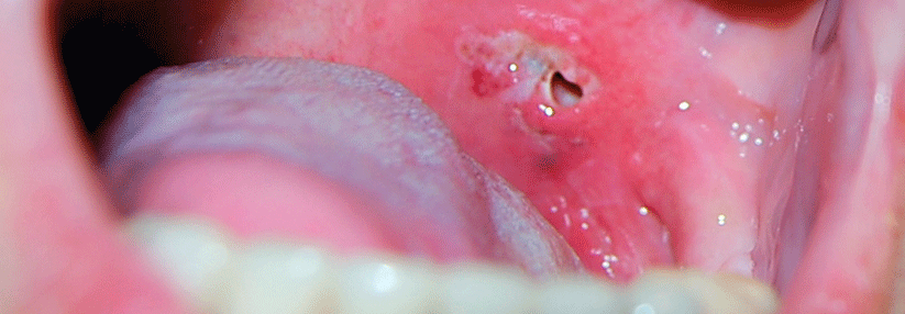 Dringen im Rahmen einer Tonsillitis Bakterien in das umgebende lockere Bindegewebe ein, droht ein Peritonsillarabszess.
