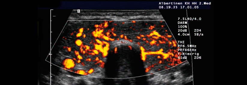 Ein regelrechtes Inferno herrscht in der Schilddrüse dieses Basedow-Patienten bedingt durch die Hypervaskularisation.