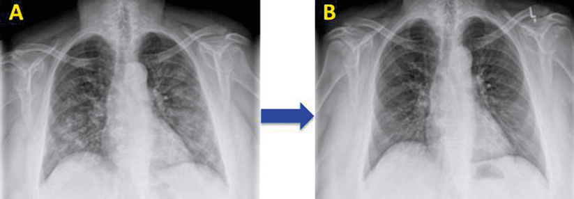 Die initialen Infiltrate als Ausdruck der
Lungenblutung bildeten sich unter der
Gabe von Immunsuppressiva zunächst zurück
(A, B).