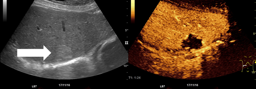 Ultraschallbilder eines Leberhämangioms im B-Bild und nach Gabe von Kontrastmittel.