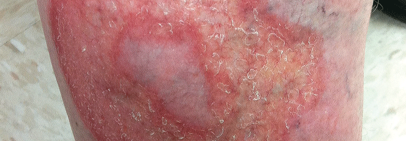 Bei der Necrobiosis lipoidica treten zunächst rote Papeln auf, die zu größeren, gelben Plaques werden.