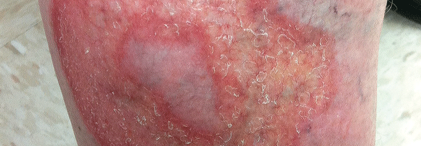 Diabetikern rückt so einiges auf die Pelle: Fahnden Sie nach Hautveränderungen wie Lichen ruber planus und "dreckigem Nacken" Bei der Necrobiosis lipoidica treten zunächst rote Papeln auf, die zu größeren, gelben Plaques werden.