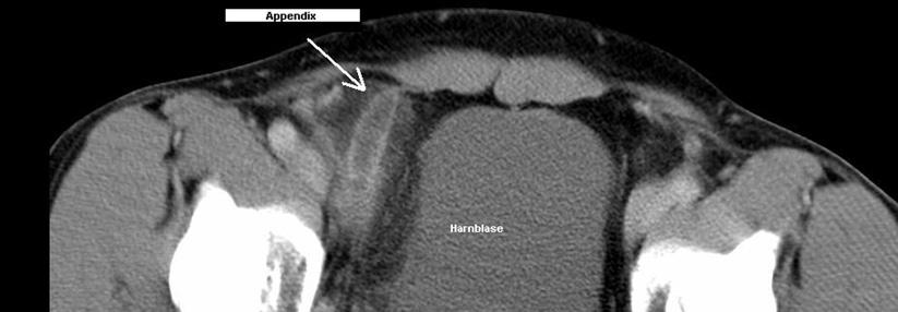 Wo Ultraschall keine klare Diagnose liefert, kann das CT Klarheit schaffen: Appendizitis