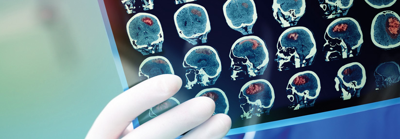 Zerebrale Metastasen treten bei 15-35 % der Patientinnen auf.