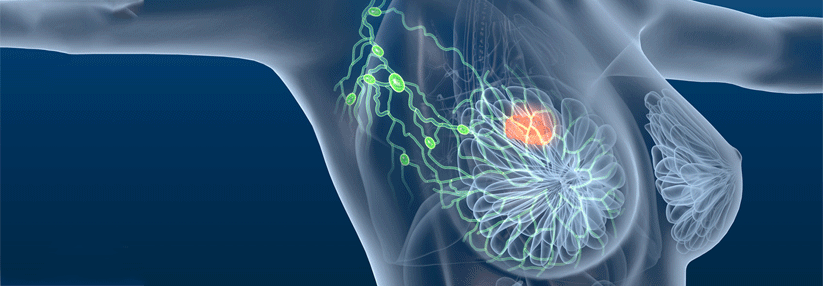 Mehr als die Hälfte der Patientinnen hatte bereits befallene Lymphknoten.