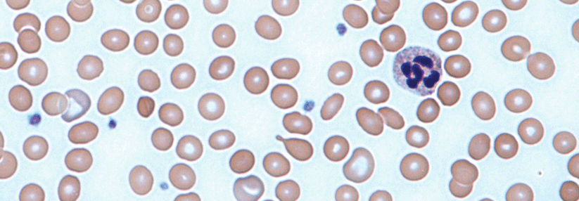 Die Blutarmut bei CED zeigt sich vorwiegend als Eisenmangelanämie, zu erkennen an den mickrigen und hypochromen Erythrozyten.