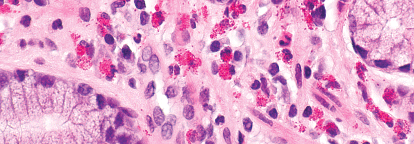 In der Magenschleimhaut wimmelte es nur so von eosinophilen Granulozyten, schön zu erkennen an den pinken intrazellulären Vesikeln.