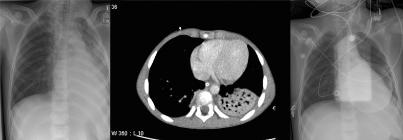 Der Erreger lässt das Immunsystem extrapulmonal für sich arbeiten und bleibt unerkannt.