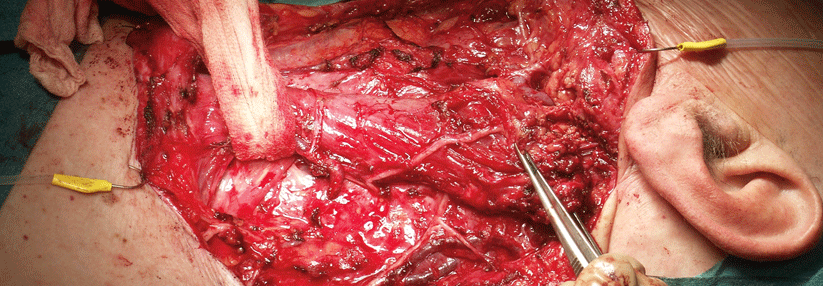 Bei diesem Chaos während einer 'neck dissection' ist es nicht verwunderlich, dass die Nebenschilddrüsen verloren gehen.
