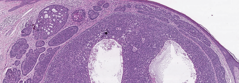 Histologie eines nodulären Basalioms