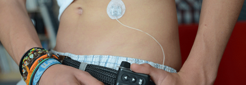 Mit Insulinpumpe und implantiertem Sensor zum perfekten Blutzuckerprofil.