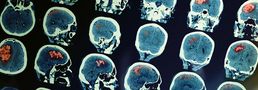 Hirnmetastasen bleiben eine gefürchtete Komplikation beim Melanom.