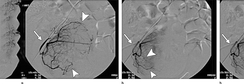 Embolisation der Arteria uterina ermöglicht Frauen mit benignen Gebärmuttertumoren, wieder fertil zu werden.