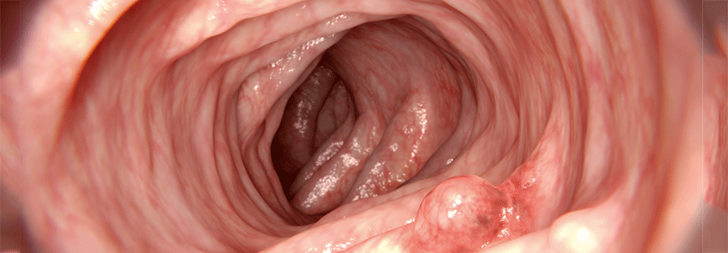 Abwarten erhöht die Wahrscheinlichkeit einer Krebsdiagnose.