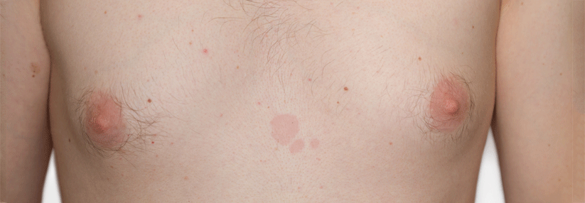 Mykose inkognito unterwegs Eigenmächtige topische Steroidtherapie lässt Pilzläsionen wie Allergie oder Psoriasis aussehen.