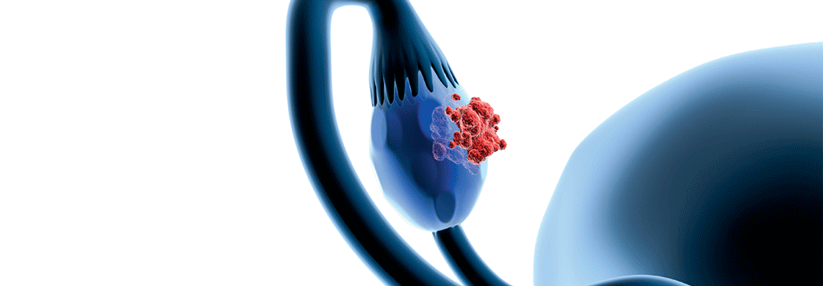 Erfolgreiche R0-Resektionen sind insbesondere beim Ovarialkarzinom von entscheidender prognostischer Bedeutung.
