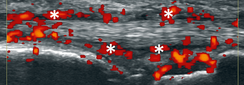 Bei dieser frühen RA bildete sich ein echofreier Saum um eine Sehne im Längsschnitt. Die hohe entzündliche Aktivität lässt sich anhand der Hyperperfusion (*) deutlich erkennen.