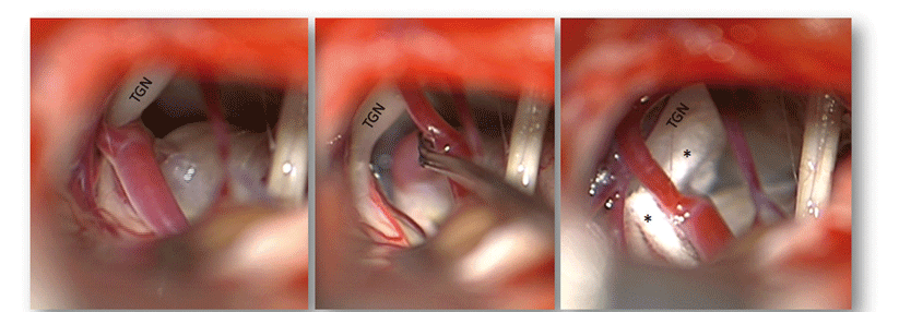 Links ist der durch ein Gefäß komprimierte Trigeminusnerv zu erkennen, in der Mitte wird das Gefäß durch einen Dissektor abgehalten, rechts sieht man das Teflonpolster zwischen Nerv und Gefäß.