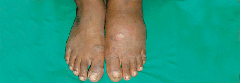 Dieser Patient leidet an einem Charcot-Fuß. Typisch für die Erkrankung ist eine diffuse, schmerzlose Schwellung.