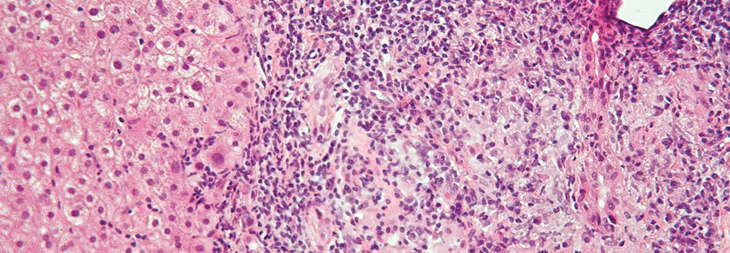 Die portale Inflammation und Granulome zählen zu den typischen histologischen Merkmalen der PBC.
