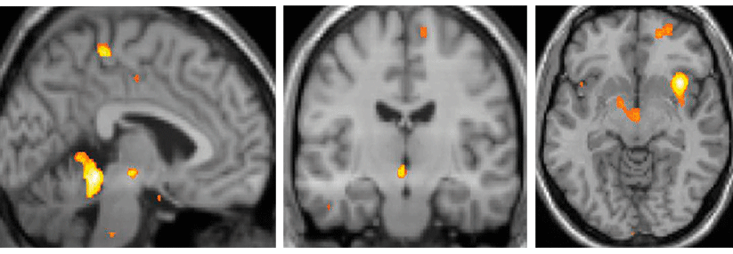 Im PET wird sichtbar, welche Hirnareale während einer Cluster-Attacke aktiv sind: die sog. Schmerzmatrix und ein Teil des Hypothalamus. 