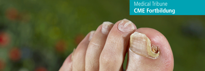 Bei Erwachsenen dauert die Therapie von Nagelpilz mehr als ein Jahr.