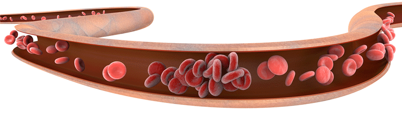 Viele Argumente sprechen für eine verlängerte Antikoagulation nach einer venösen Thromboembolie.
