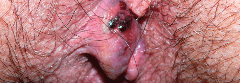 Ein großer perianaler Thrombus kann spontan platzen. Dadurch lässt der Schmerz nach. In der Unterhose finden sich dann oft dunkle Krümel.