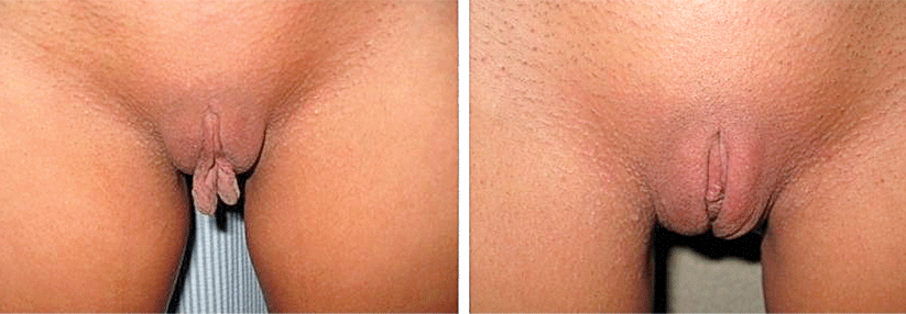 Pro Jahr werden weltweit bei rund 100 000 Frauen die inneren Schamlippen gekürzt. Etwa halb so viele lassen sich die Vagina straffen.
