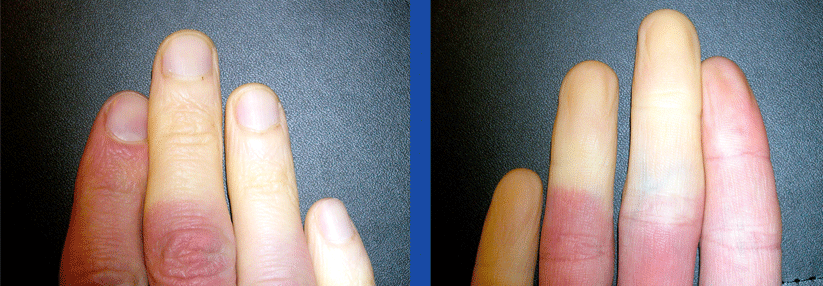 Erst weiß, dann blau, dann rot: Die phasenweise Verfärbungen der Finger nennt sich Trikolore-Phänomen.