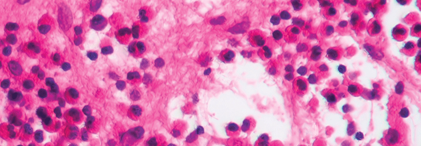 Bei allergischer Rhinosinusitis finden sich zahlreiche Eosinophile. Hier helfen topische Steroide.