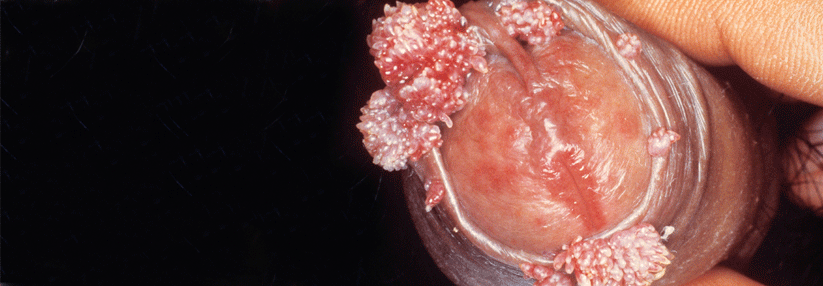 Werden Condylomata nicht rechtzeitig behandelt, wächst ein sogenanntes Warzenbeet.