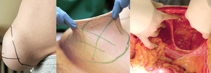 Prall gefüllt mit Darmschlingen sticht die 20 x 20 cm große Bauchwandhernie heraus (links). Zwei Wochen nach der Botulinumtoxin-Injektion ist die Hernie nahezu komplett retrahiert (Mitte). Intraoperativ zeigt sich das ganze Ausmaß des Bruchsacks (rechts).