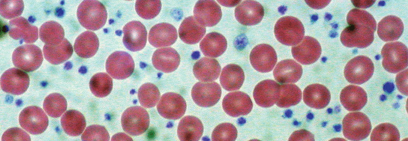 Dieser Patient mit essenzieller Thrombozythämie hat rund zwei Mio. Plättchen (blau) in jedem µl Blut.