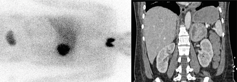 Den Tumor findet man am besten mit einer Kombi aus CT und Szintigraphie.