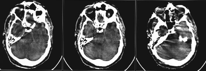 Das Risiko hämorrhagischer Hirninfarkte steigt bei niedrigen Cho­lesterinspiegeln.