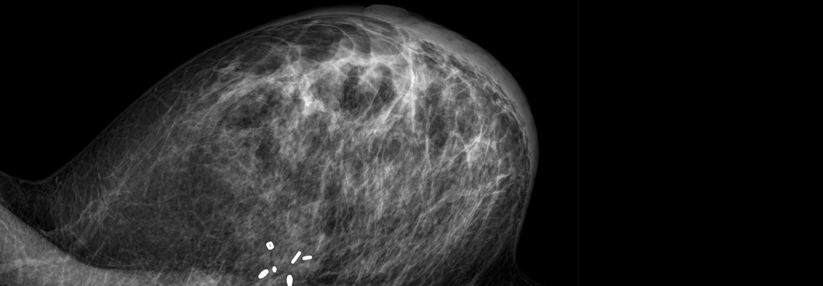 Für frühe Mammographien (vor dem 30. Lebensjahr) ermittelten die Autoren einen Anstieg des relativen Risikos um 43 %.