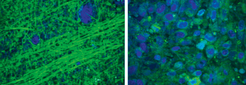Im SRS-Mikroskop kann man gesundes Gewebe (links) gut vom Tumor (rechts) unterscheiden.
