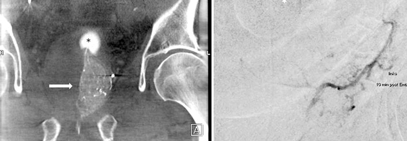 Unmittelbar vor der Embolisation wird mittels CT überprüft, ob der Katheter richtig liegt und die Prostata kontrastiert (links). Zehn Minuten später zeigt sich im Röntgenbild eine Stase (rechts).