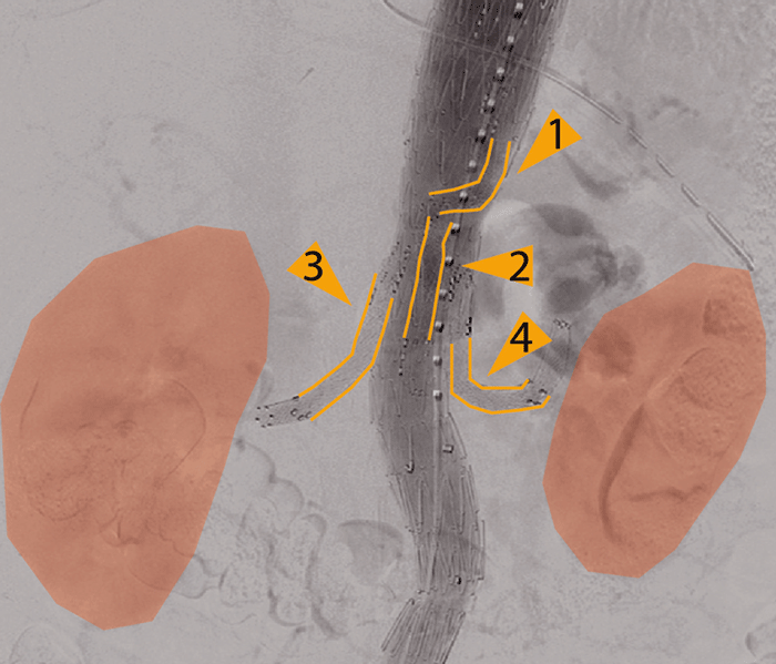 Dieses thorakoabdominelle Aortenaneurysmas wurde mit einem Stent ausgeschaltet, hier erkennt man das Nierenparenchym
(orange) – zum Anschluss an Truncus coeliacus (1), Arteria mesenterica superior (2) und beide Nierenarterien (3,4).